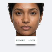 Acne 360